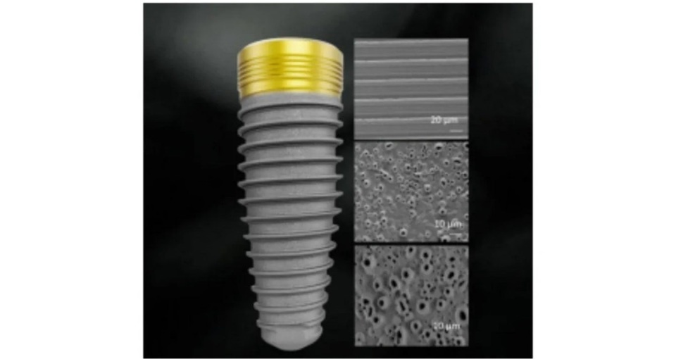 种植牙材料诺贝尔怎么样,瑞士诺贝尔高端种植牙
