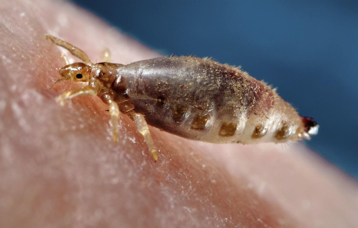 虱子在头上有什么危害,虱子对人体有哪些害处