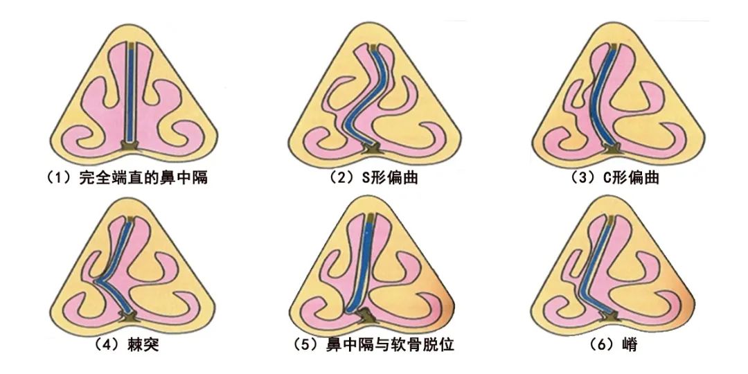 没感冒鼻子不通气是什么原因,鼻子不通气冒火什么原因引起