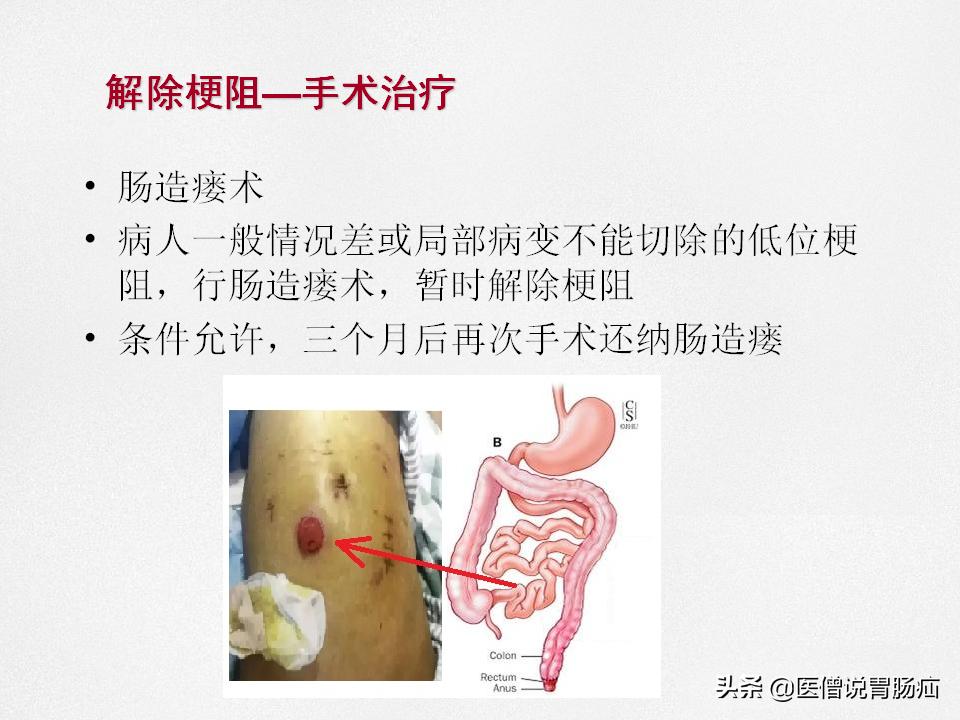肠梗阻健康教育,肠梗阻患者的健康宣教