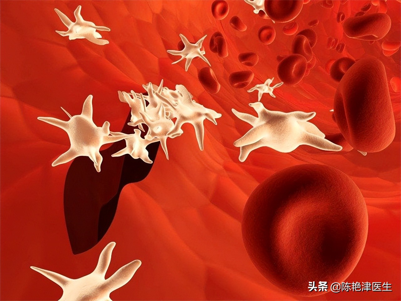 突发脑梗的五个信号,脑血栓脑袋滋滋的声音