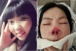 男子咬掉妻子鼻子原因是什么,男子咬掉妻子鼻子后续原因是什么