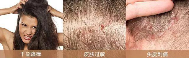 染发过程中头皮刺痛正常吗,染发过程中头皮痒正常吗