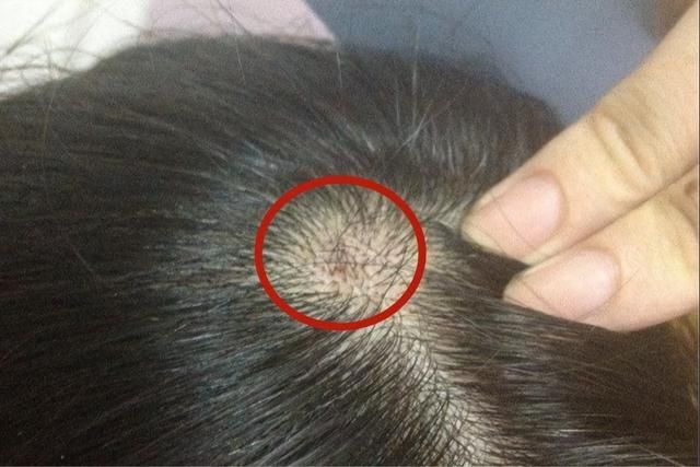头皮为什么总长疙瘩和脓包,头皮总是长疙瘩或脓包是什么原因