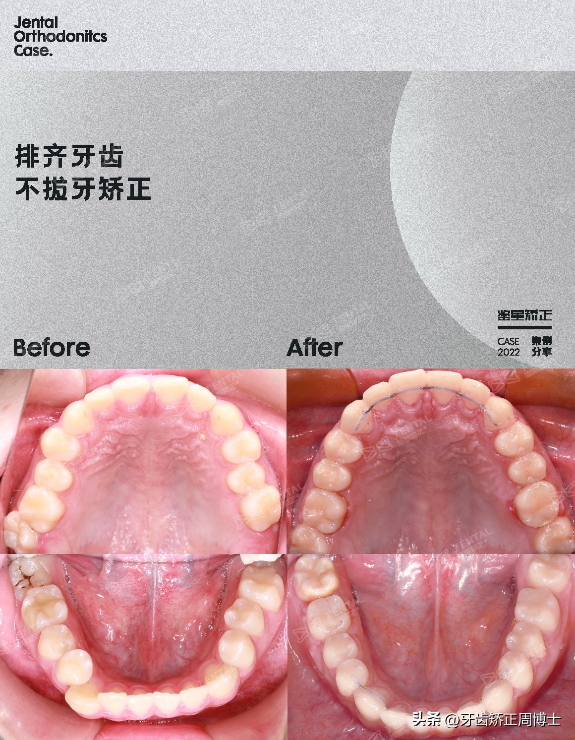 小孩牙齿为什么迟迟不长,孩子牙齿刚长出来不齐怎么办