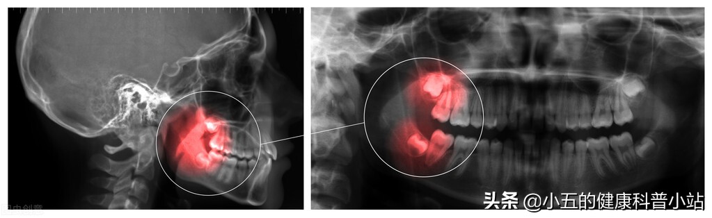 智齿又不长了怎么会顶坏牙,智齿一直长不出来有什么危害