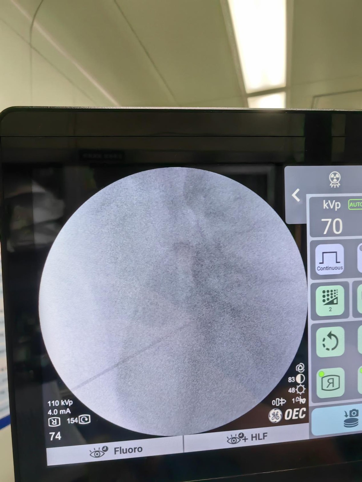 腰椎间盘突出微创姑息法,38岁腰椎间盘突出微创