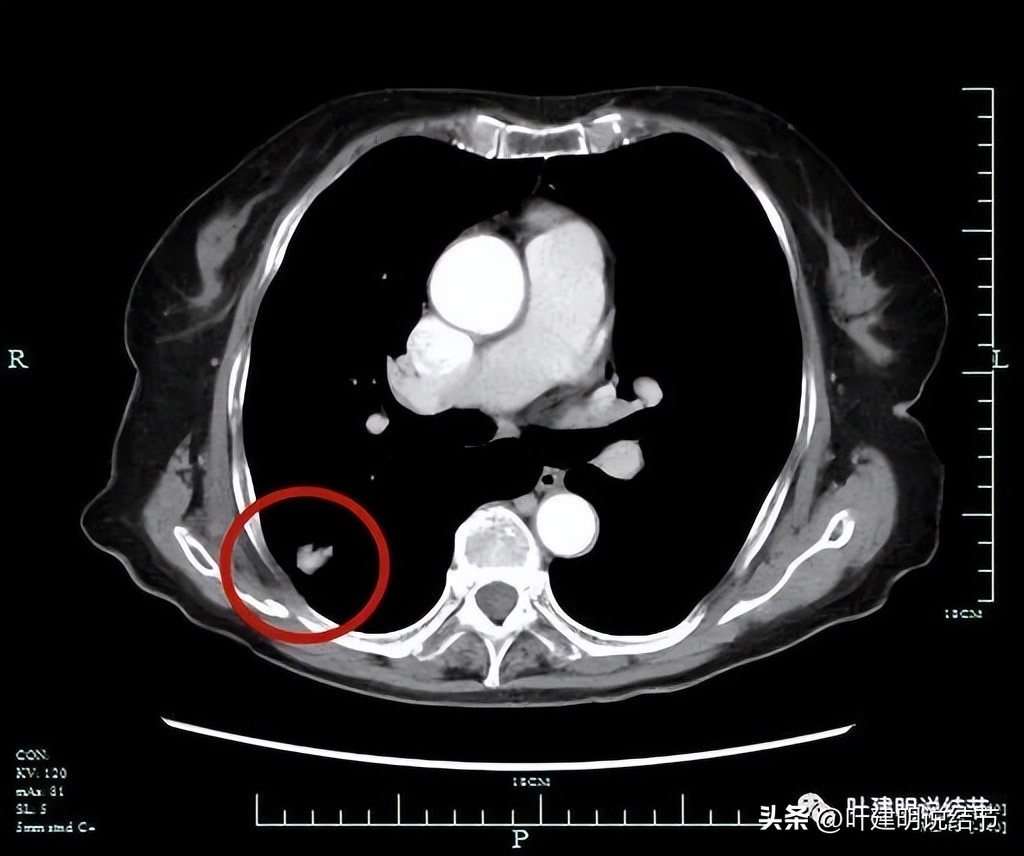 79岁肺癌早期手术风险,75岁早期浸润性肺癌还要治疗吗
