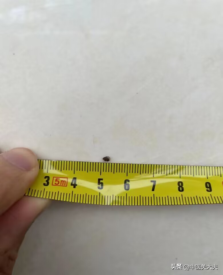 29岁男子肾结石,27岁输尿管一颗肾结石