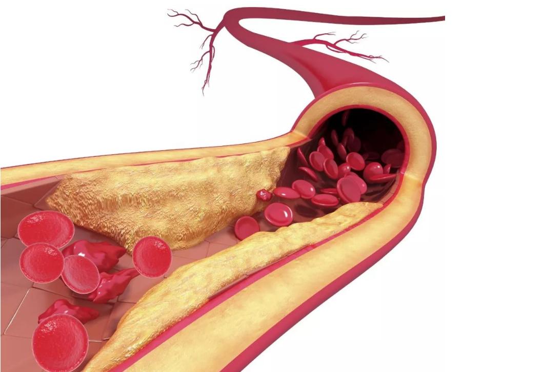 阿司匹林吃时间长了会鼻子出血吗,阿司匹林吃久了血管会变脆