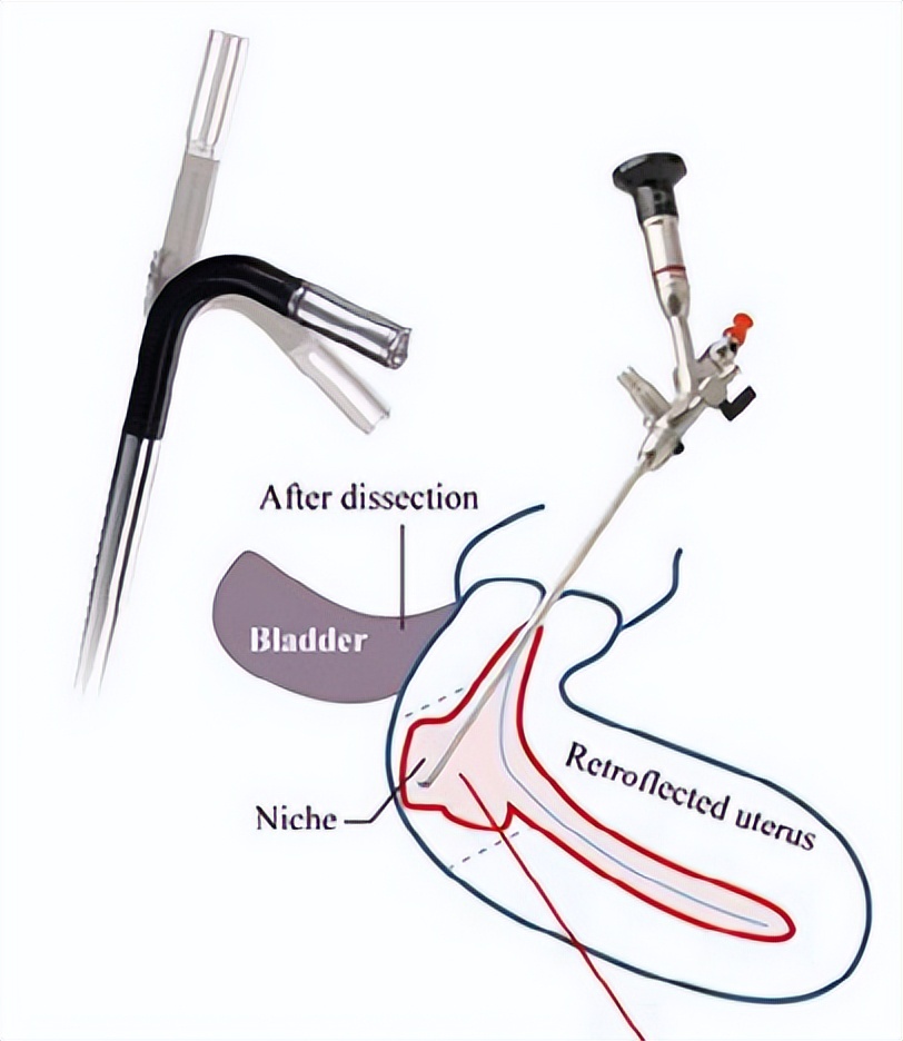 子宫憩室经期延长危害,子宫切口憩室做手术可以痊愈吗