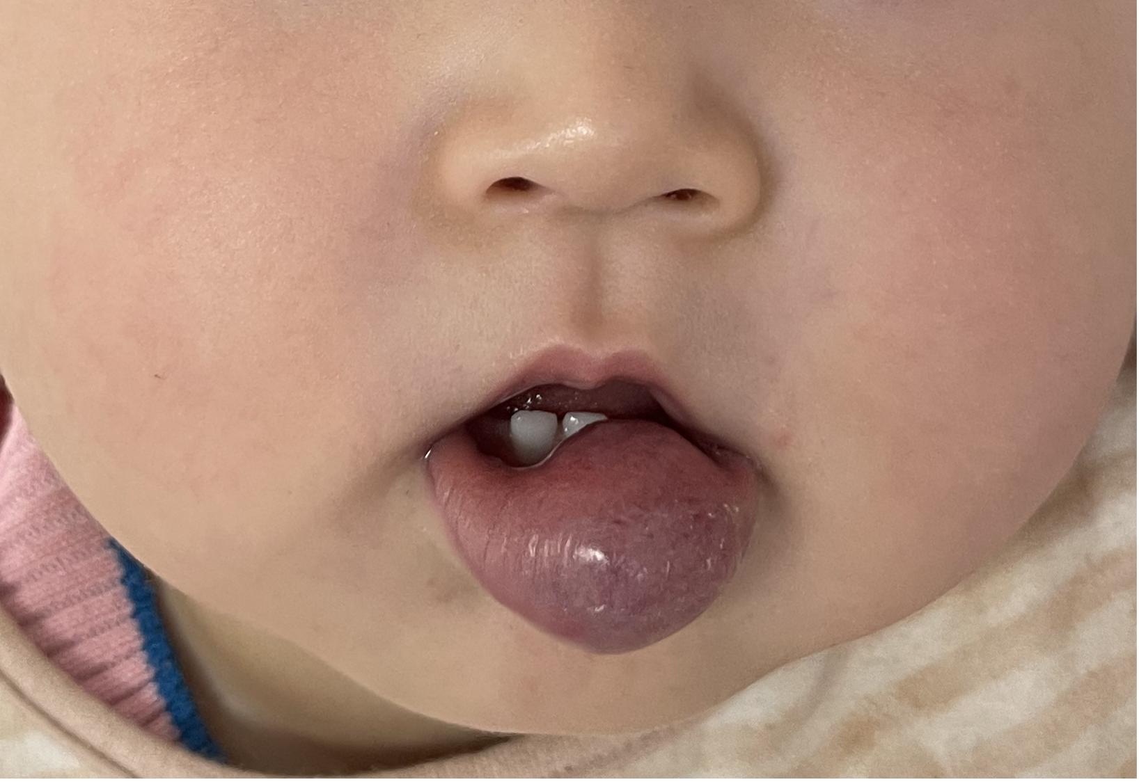 唇血管瘤,嘴唇血管瘤介入治疗过程