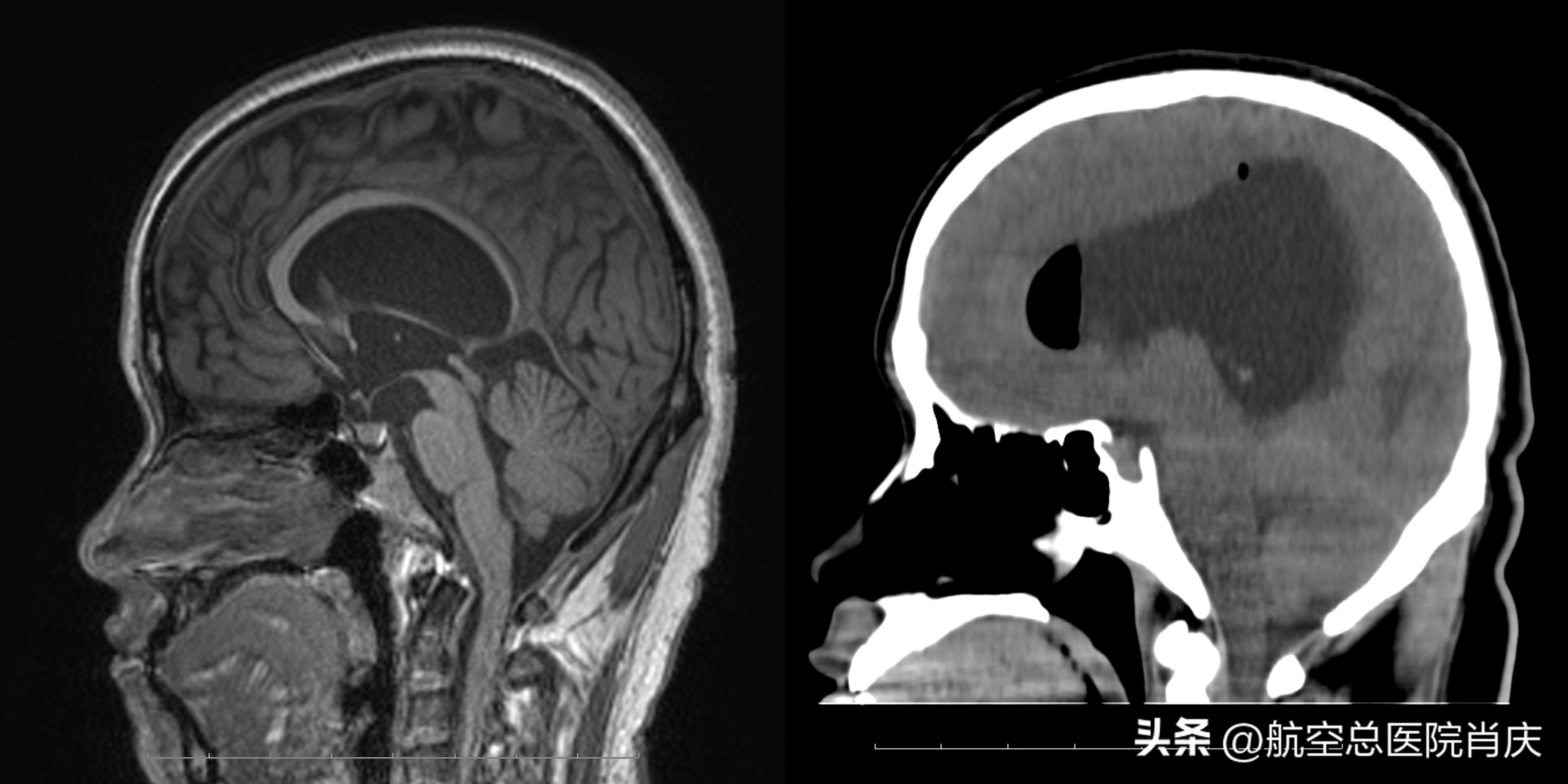 脑积水手术治疗方法最普遍,脑积水的微创治疗