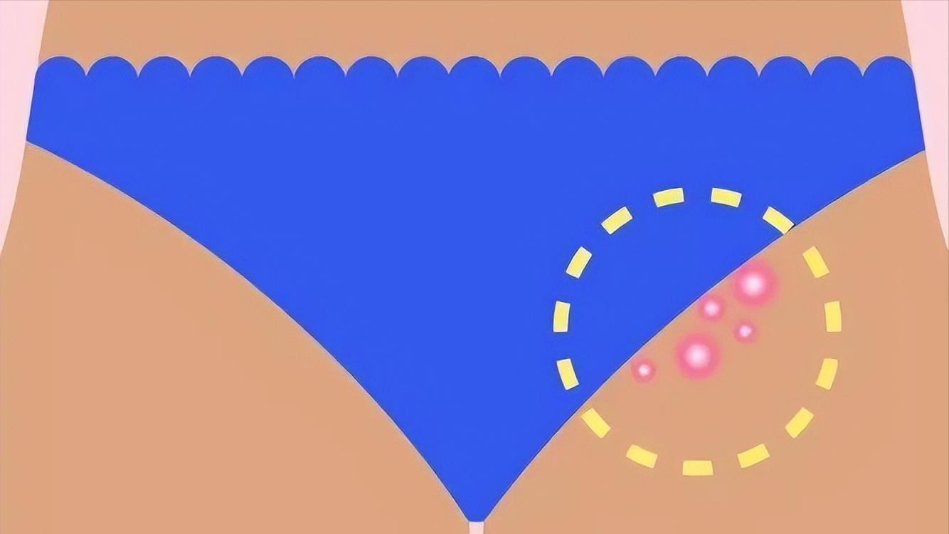 脖子下面长痘痘是什么原因,脸下面长痘痘是什么原因