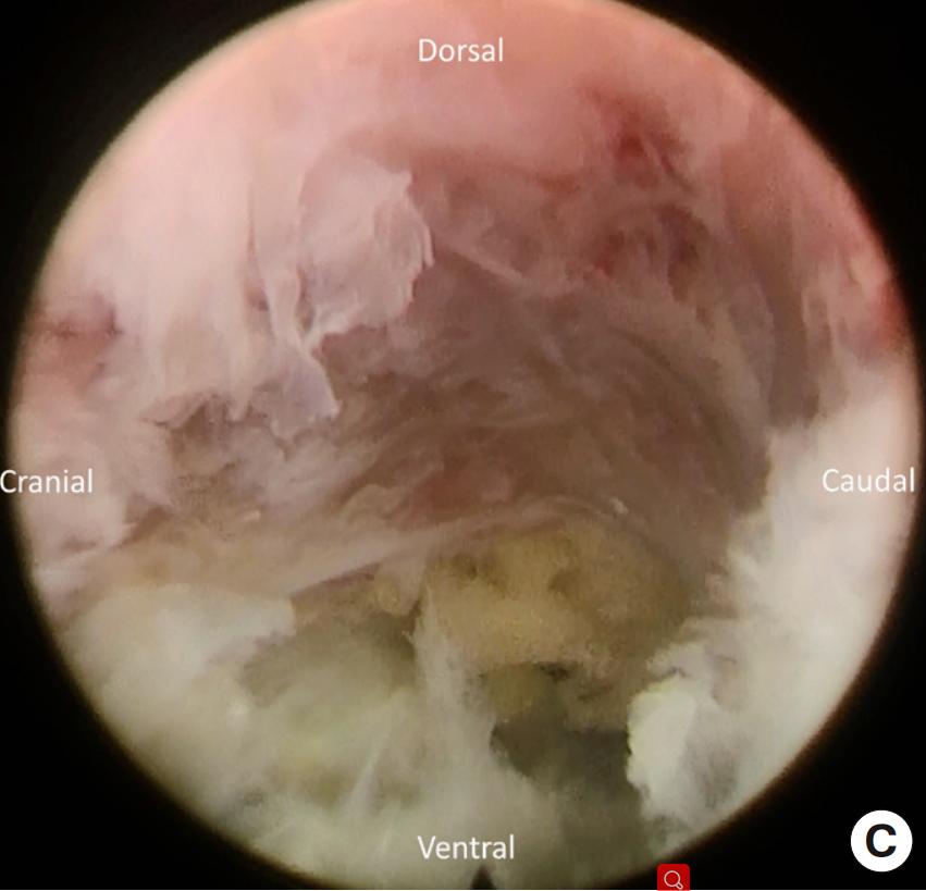 椎间孔镜微创介入治疗椎间盘突出,腰3-4椎间盘突出针刀治疗