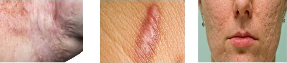 疤痕发黑发硬变厚怎么解决,疤痕凸起变硬如何处理