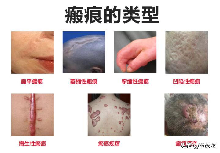 瘢痕保守处理,瘢痕要早期干预治疗