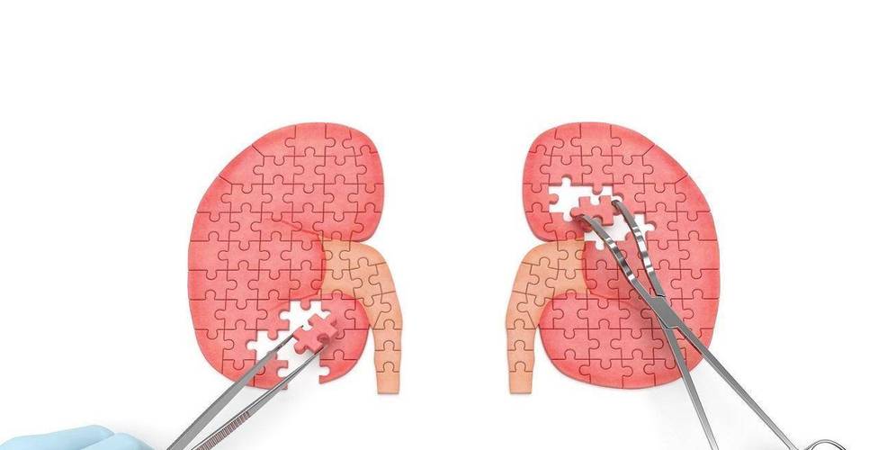 腹腔镜肾切除示意图,腹腔镜肾脏部分切除术