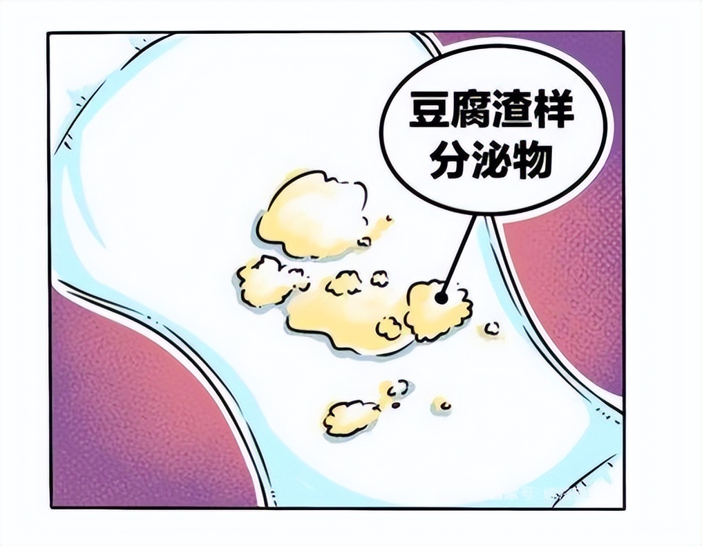 医生：我下面瘙痒还有豆腐渣一样的分泌物是怎么回事？