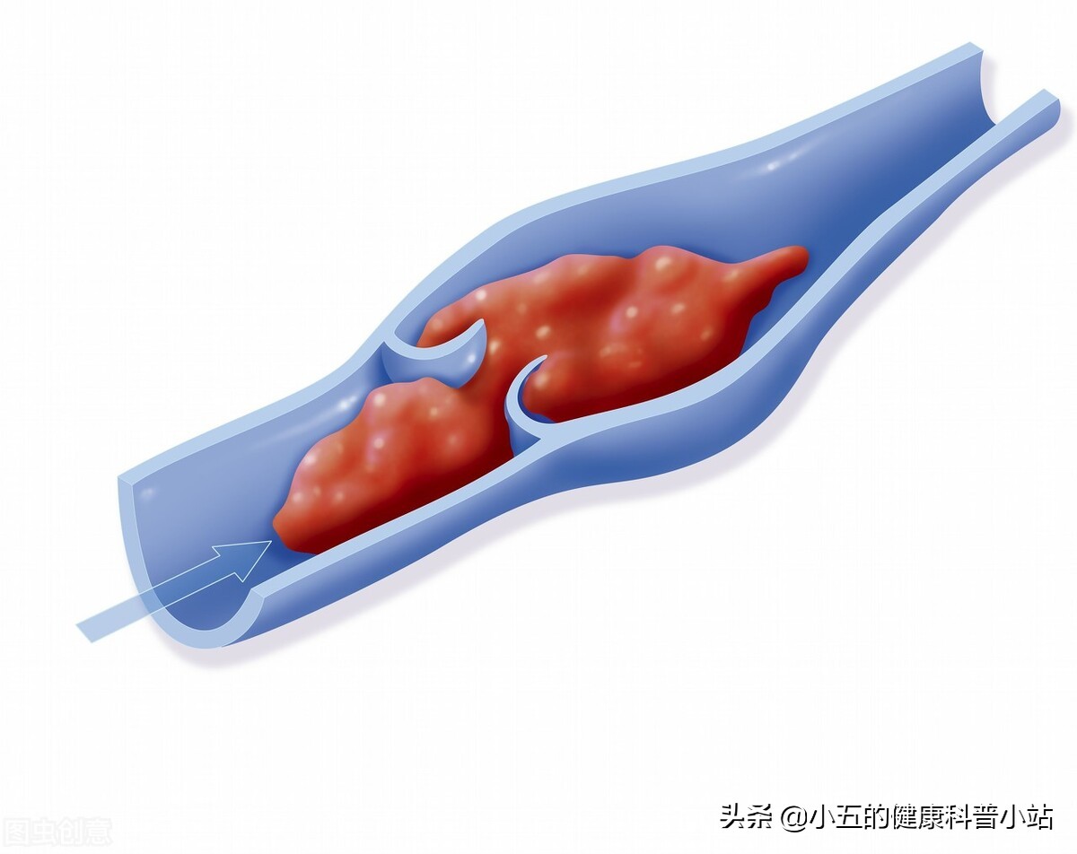 利伐沙班可以治疗动脉血栓吗,利伐沙班治疗血栓应服多长时间