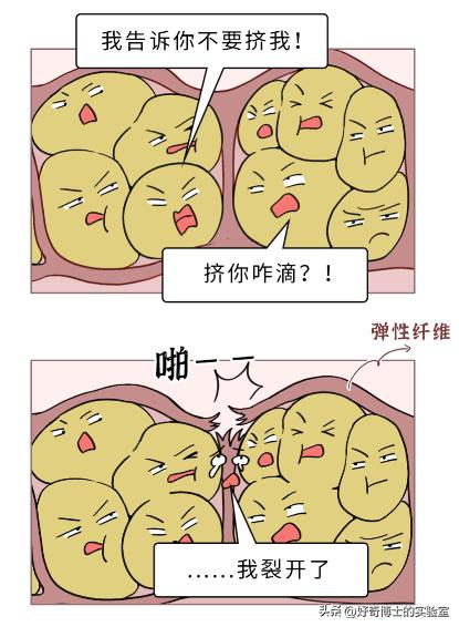 女生大腿外侧出现小条纹,为什么女生大腿上会有条纹