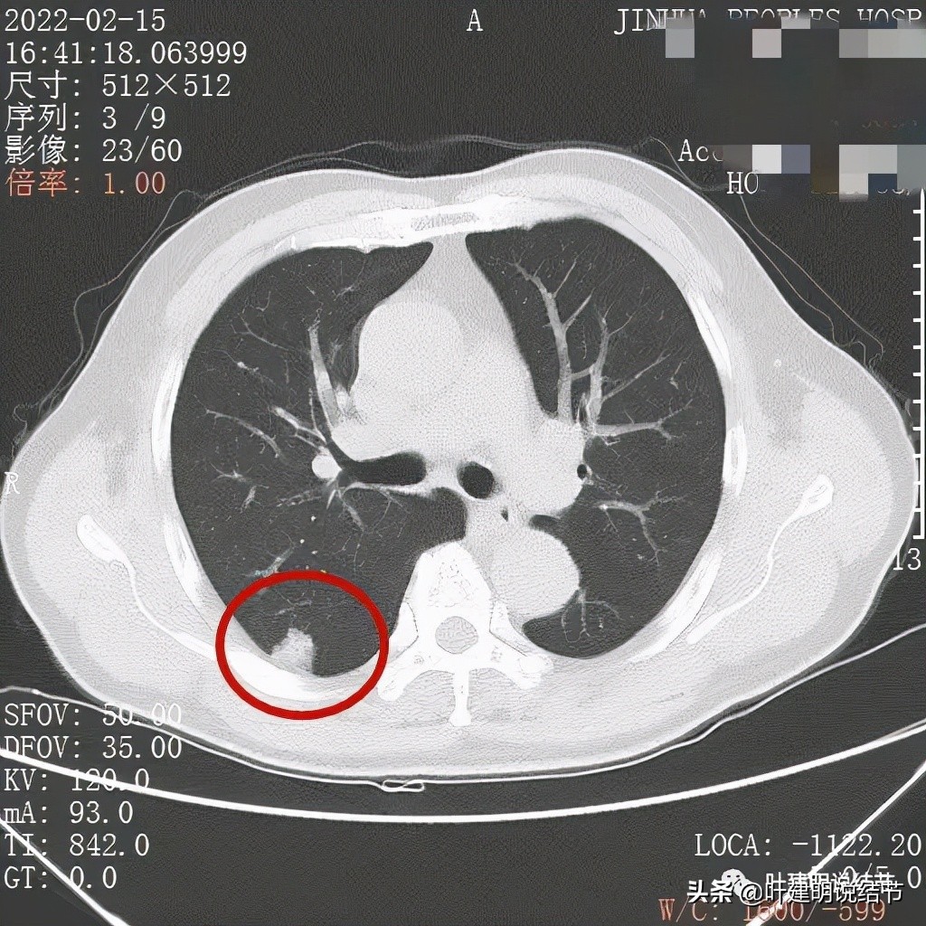 肺腺癌高危亚型什么意思,肺腺癌高危亚型