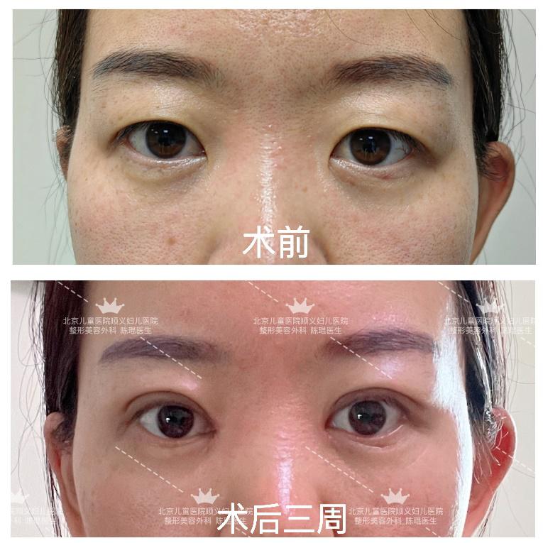 常见三种双眼皮手术的比较与分析,你应该选择哪种双眼皮手术方法