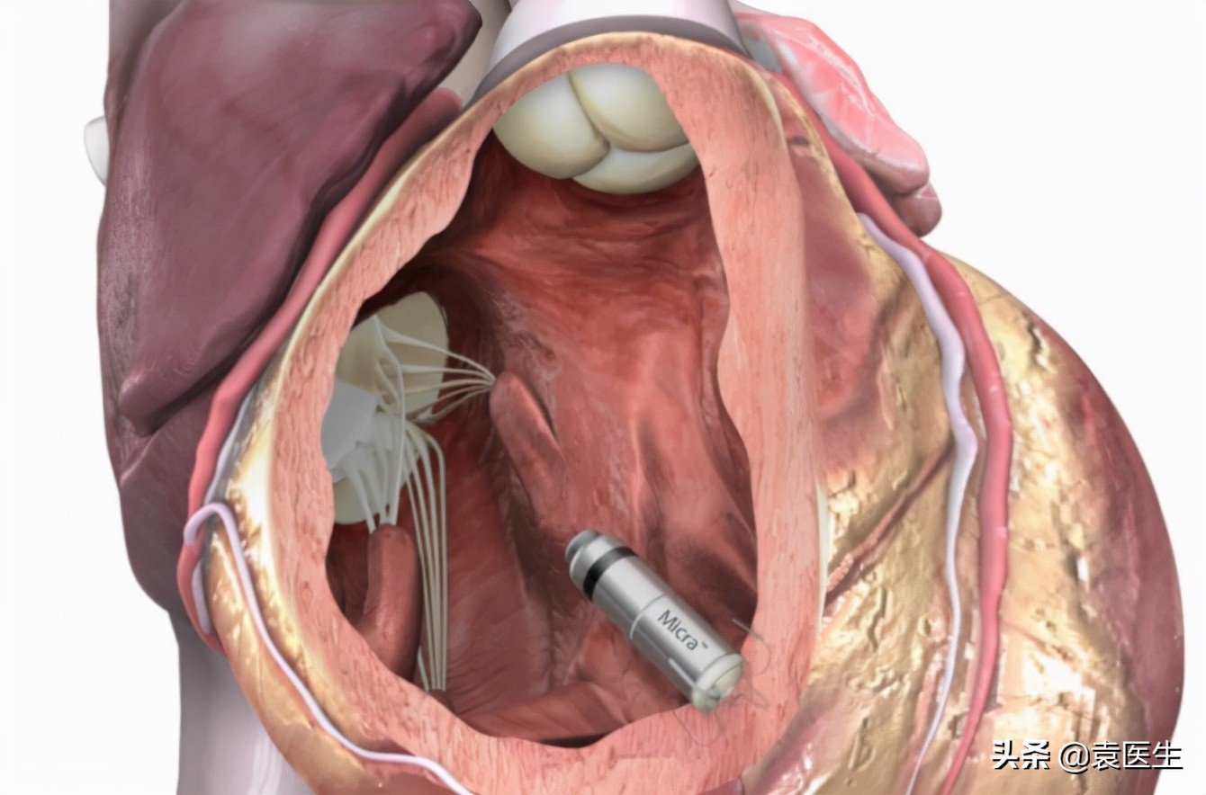 心脏装起搏器是因为心率慢吗,心脏跳得慢多少需要安起搏器