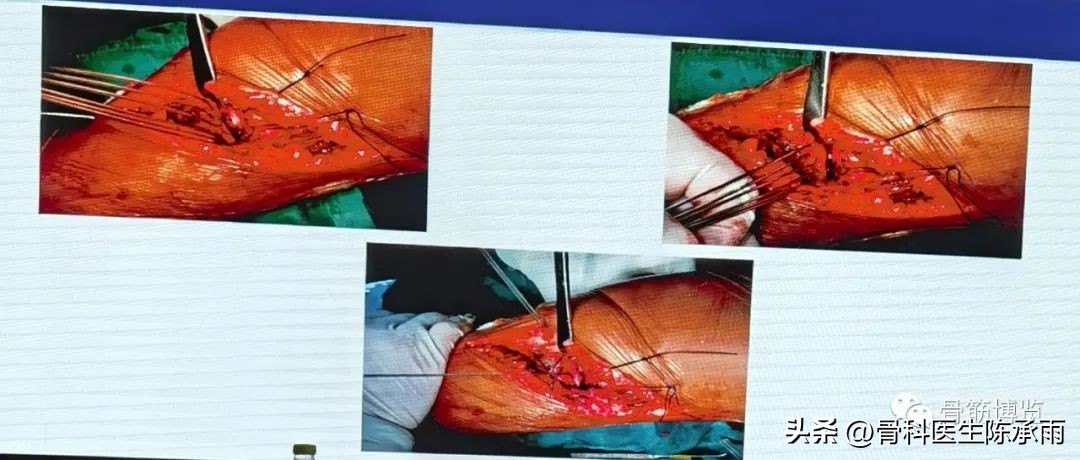 国家卫健委主办的骨创伤专项能力培训项目----下肢损伤学习班