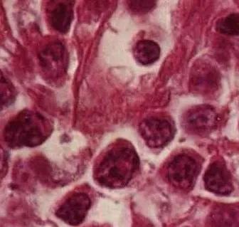 医考临床基础知识,胃恶性淋巴瘤存活期