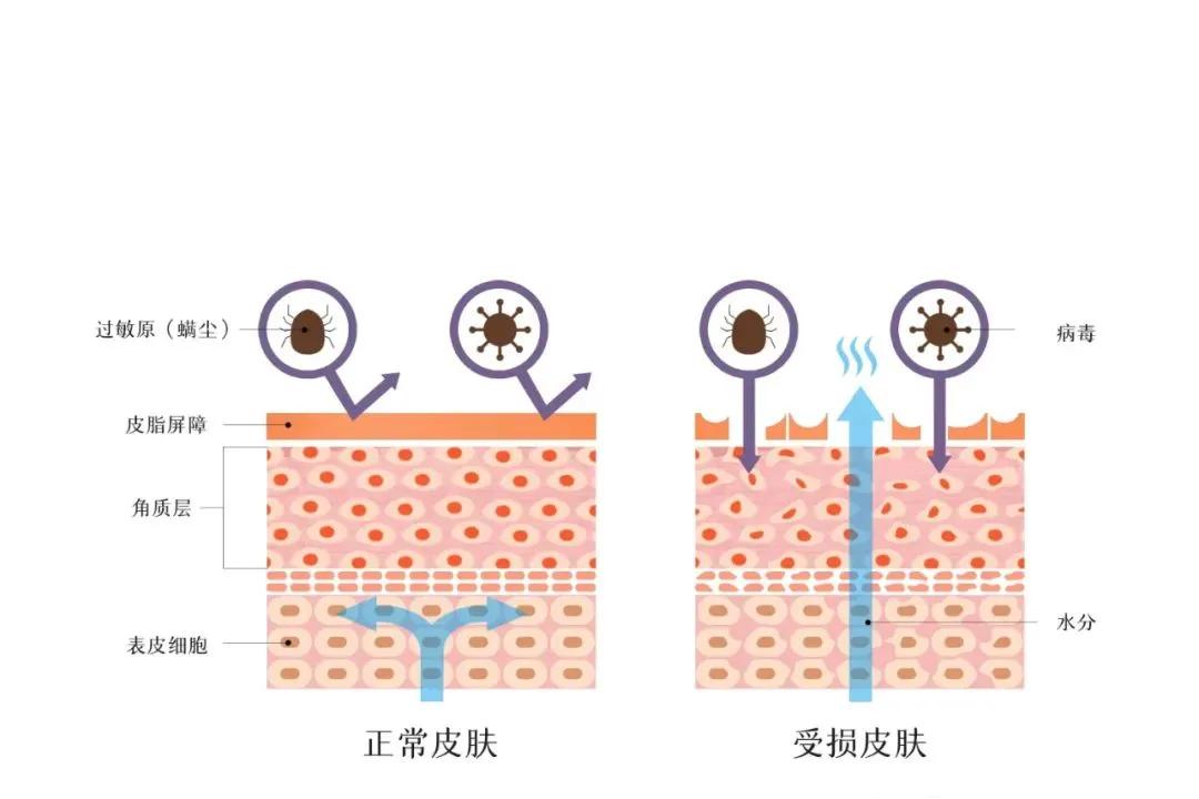 敏感皮肤的护理方法,皮肤油敏感泛红怎么修复