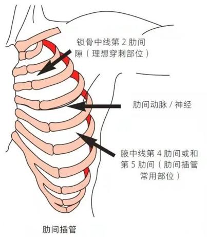 气胸插管排气后呼吸依然很痛,气胸呼吸时咯吱响