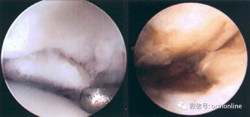 髌骨软化症的最佳疗法是什么,髌骨软化症治疗方法以及康复训练
