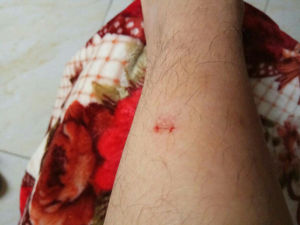 一旦发作就会死的病,人兽共患传染病