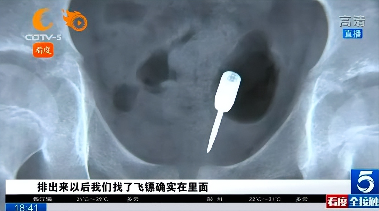 浙江14岁男孩体内取出19颗磁力珠,十一岁男孩吞磁珠