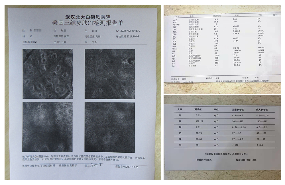 儿童眼皮白癜风能自动痊愈吗,眼睛白癜风睫毛也白了能治好吗