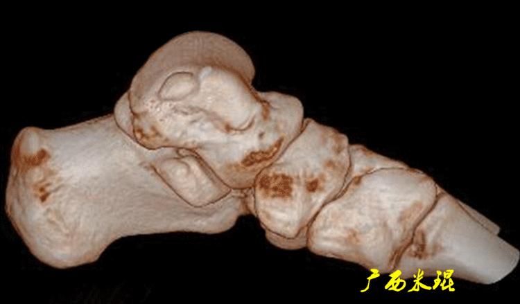 距骨软骨损伤最好的治疗方法,距骨软骨损伤的诊断