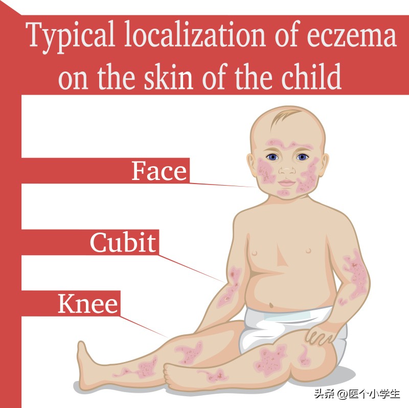 婴儿皮肤过敏了怎么办最快方法,婴儿皮肤过敏怎么护理最有效