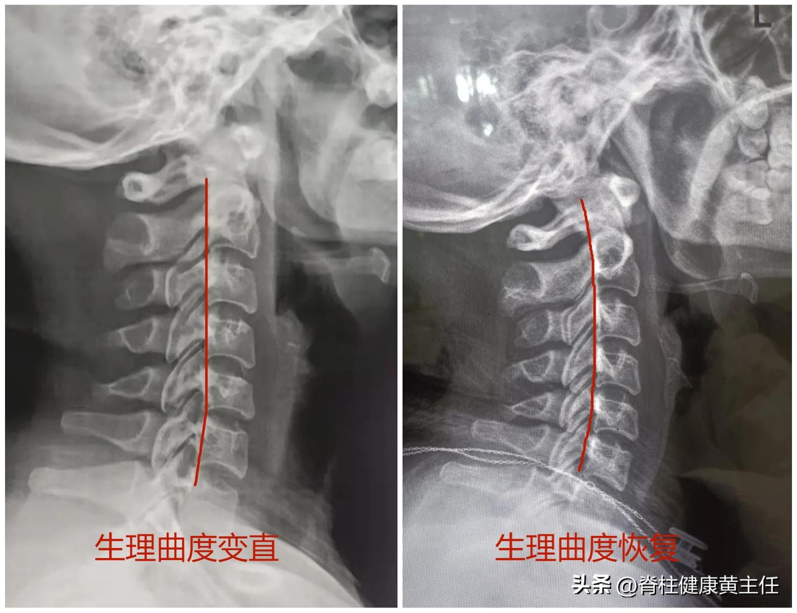 颈椎病曲度变直后如何矫正,颈椎生理曲度变直怎么治疗和恢复