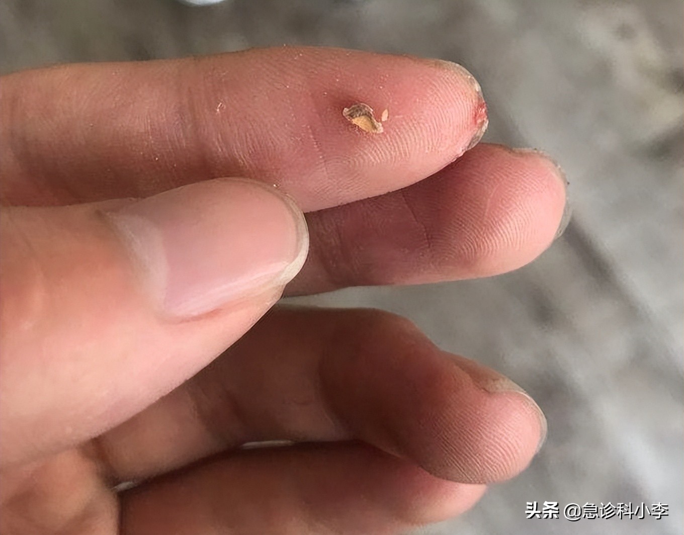 牙缝间的牙结石怎么清除,牙缝里的牙结石怎么去除