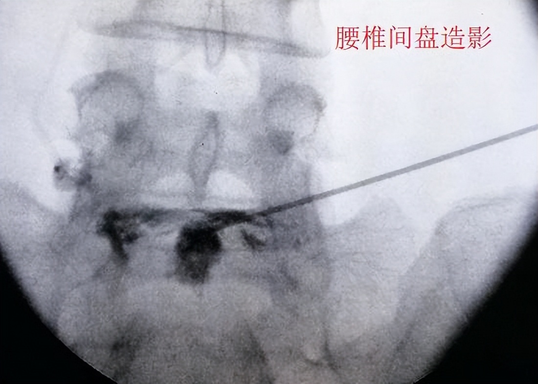 腰椎间盘突出诱发疼痛的原因及应对方法