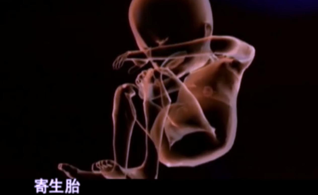 2007年四川90岁老妇，腹中怀子60年未生，后检查发现胎儿没有腐烂