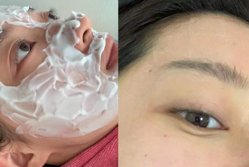 收缩毛孔激光点阵真实效果,毛孔缩小最有效的办法用点阵激光