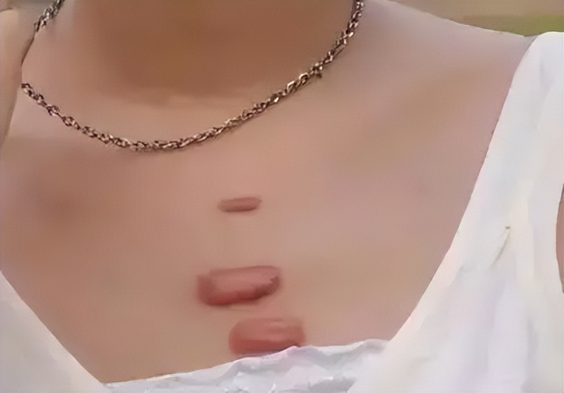 疤痕疙瘩破了出脓怎么治,疤痕疙瘩破溃怎么治疗