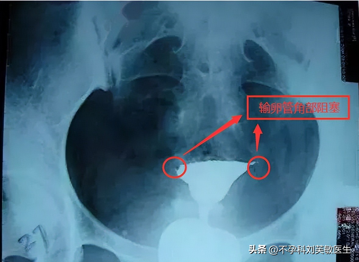 输卵管造影怎么看片子图解,最新的输卵管造影方法