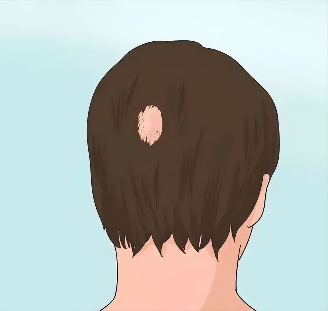 火针治疗斑秃一般多久治疗一次,火针治疗斑秃的效果好不好