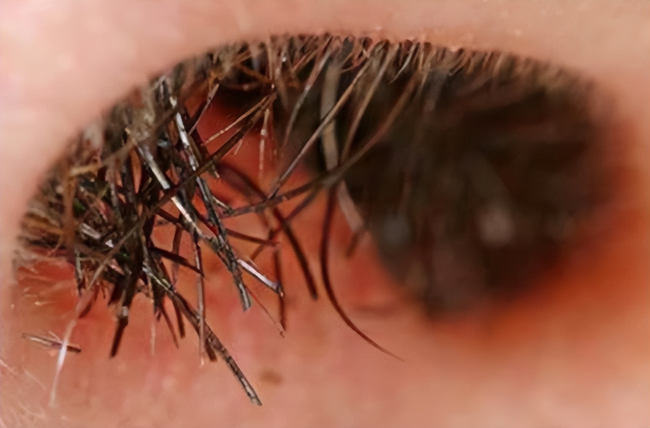 鼻毛变白是哪些原因造成的,鼻毛变白真的是衰老吗