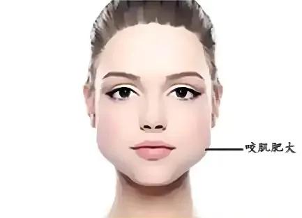 注射瘦脸针消除咬肌,打完瘦脸针会面部凹陷吗