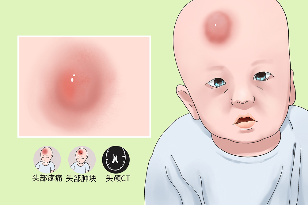 头皮血肿需要怎样处理,头皮血肿怎么办如何正确实施急救