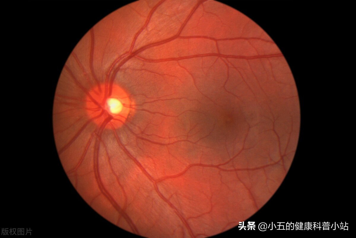 西格列汀治疗糖尿病会减重吗,西格列汀治疗糖尿病效果及价格